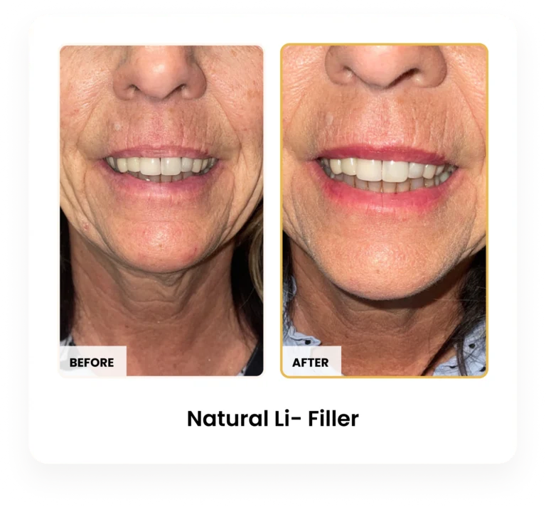 Natural Lip Filler before and after results at Blessed Beauty Boutique in Phoenix, Arizona