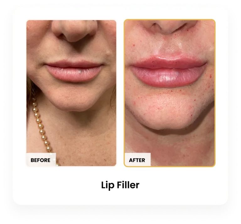 Lip Filler before and after results at Blessed Beauty Boutique in Phoenix, Arizona