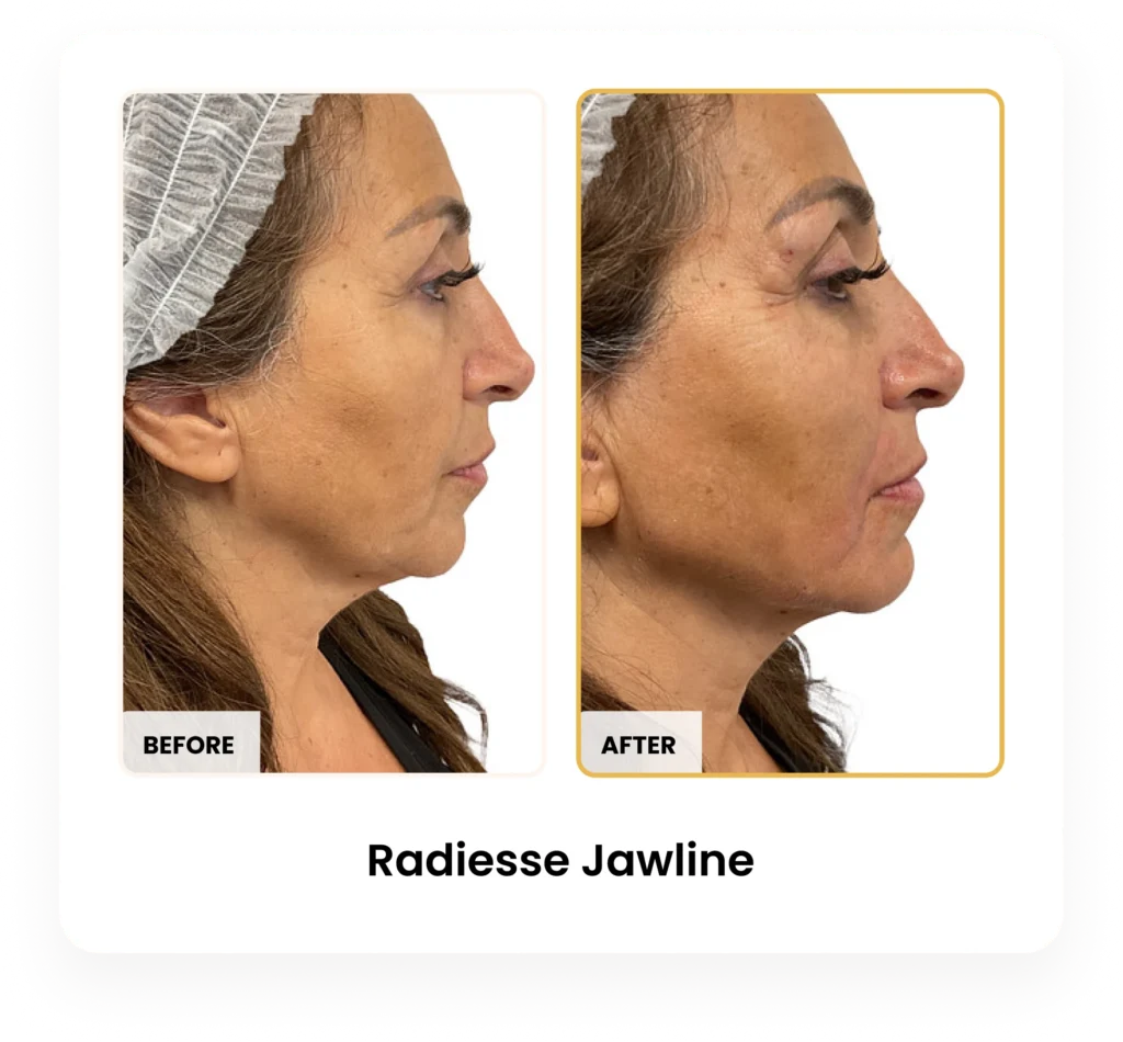 Radiesse Jawline before and after results at Blessed Beauty Boutique in Phoenix, Arizona