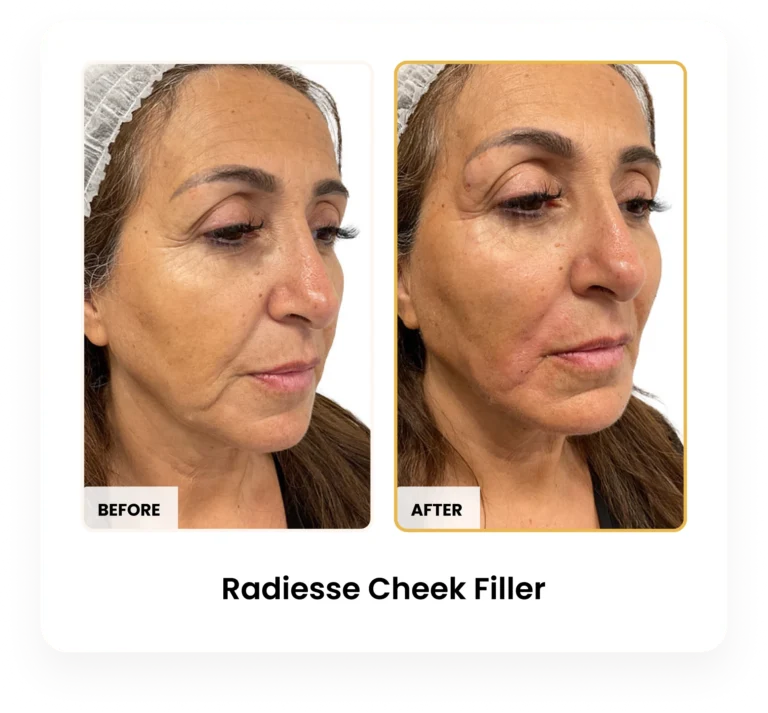 Radiesse Cheek Filler before and after results at Blessed Beauty Boutique in Phoenix, Arizona
