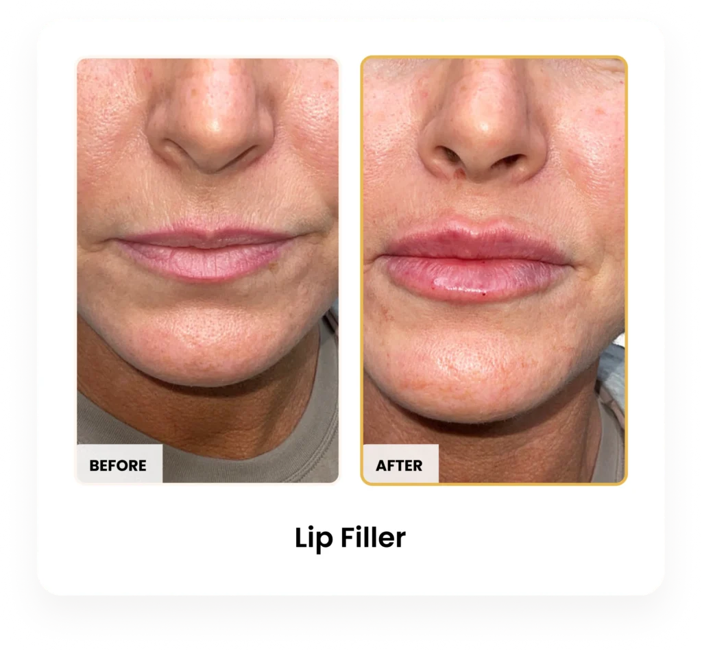 Lip Filler before and after results at Blessed Beauty Boutique in Phoenix, Arizona