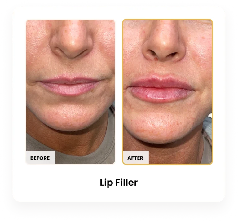 Lip Filler before and after results at Blessed Beauty Boutique in Phoenix, Arizona