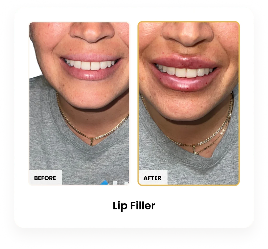 Lip Filler before and after results at Blessed Beauty Boutique in Phoenix, Arizona