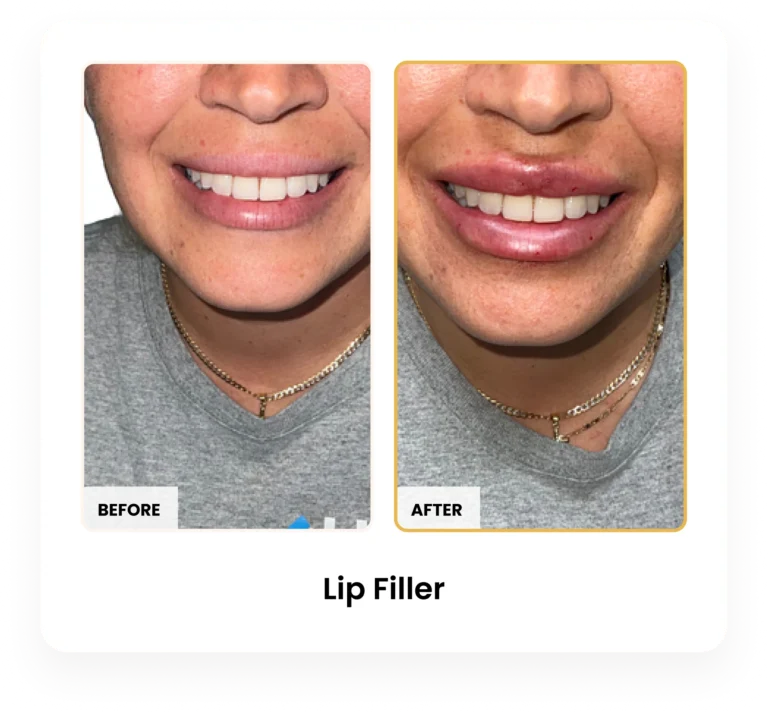 Lip Filler before and after results at Blessed Beauty Boutique in Phoenix, Arizona