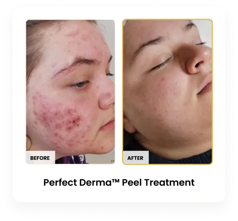 Perfect Derma Peel before and after results at Blessed Beauty Boutique in Phoenix, Arizona