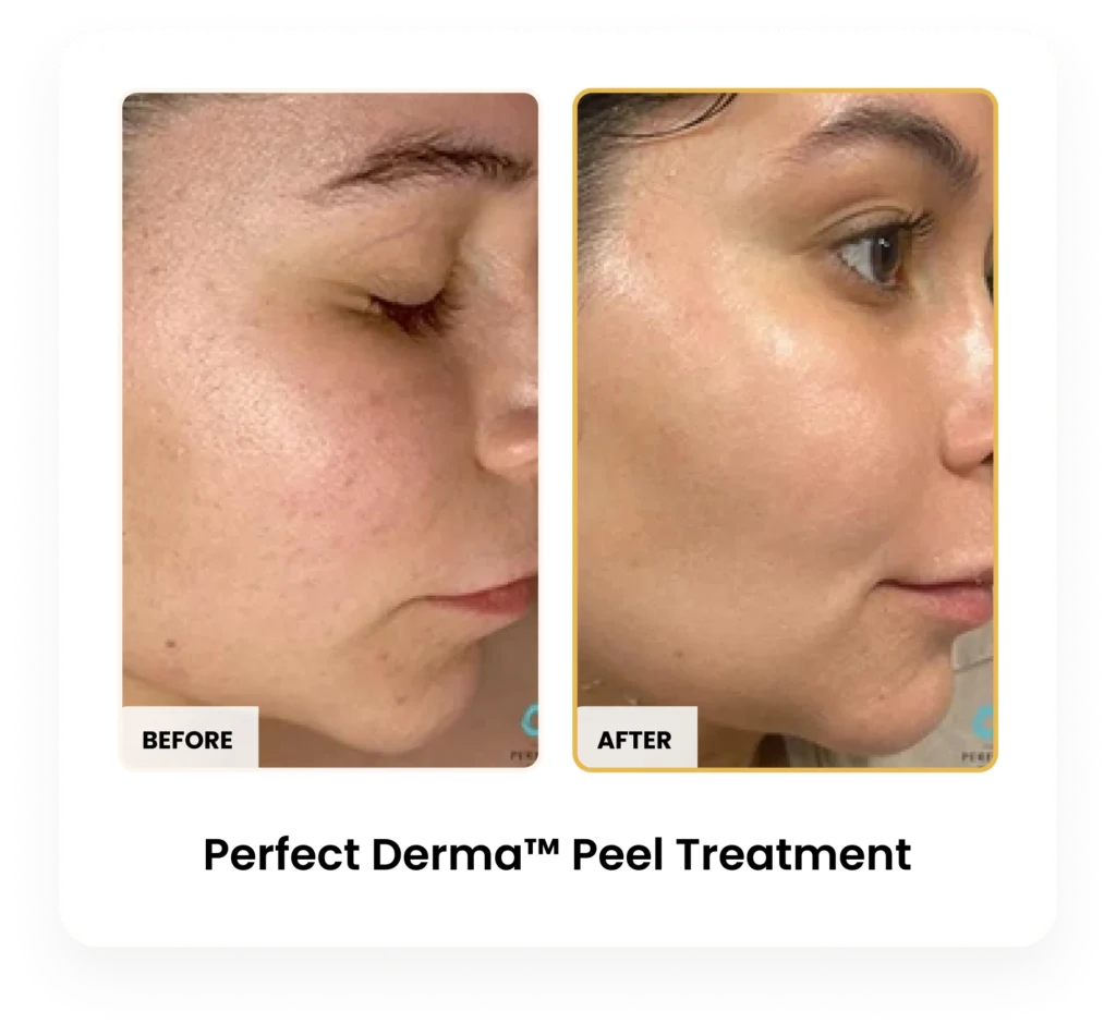 Perfect Derma Peel before and after results at Blessed Beauty Boutique in Phoenix, Arizona