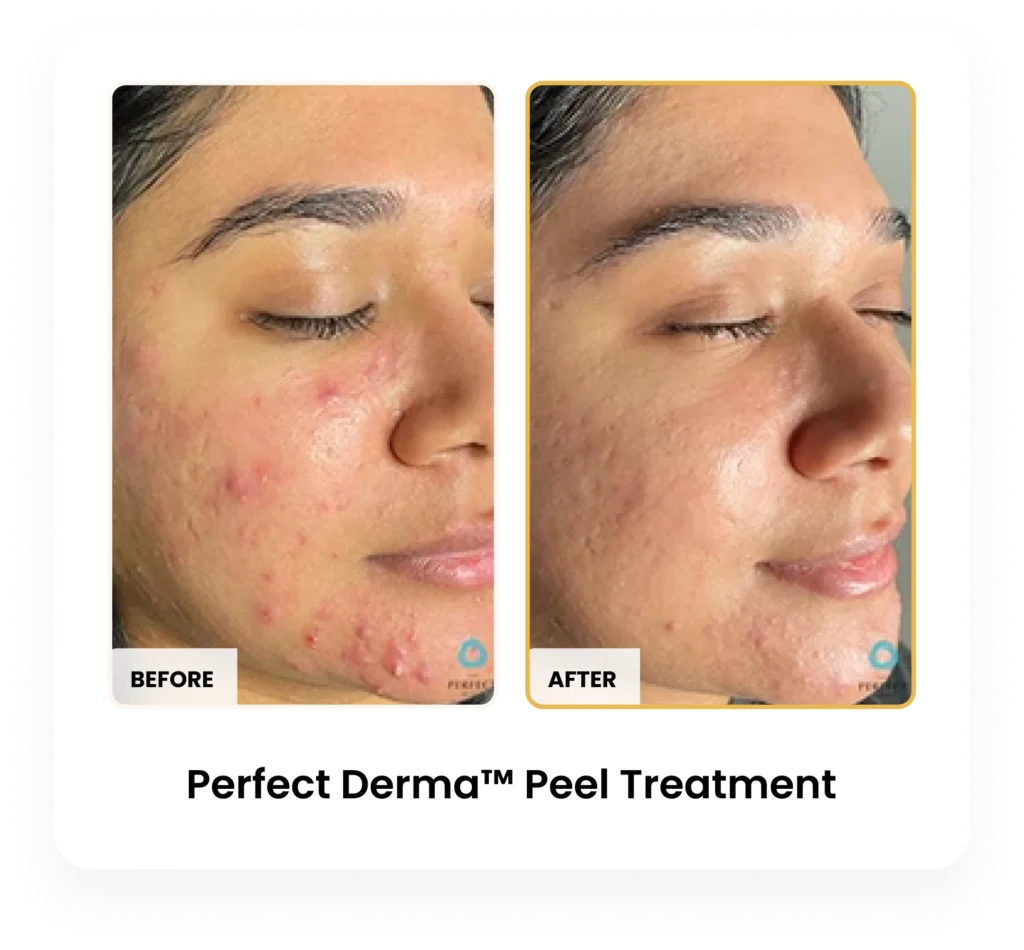 Perfect Derma Peel before and after results at Blessed Beauty Boutique in Phoenix, Arizona