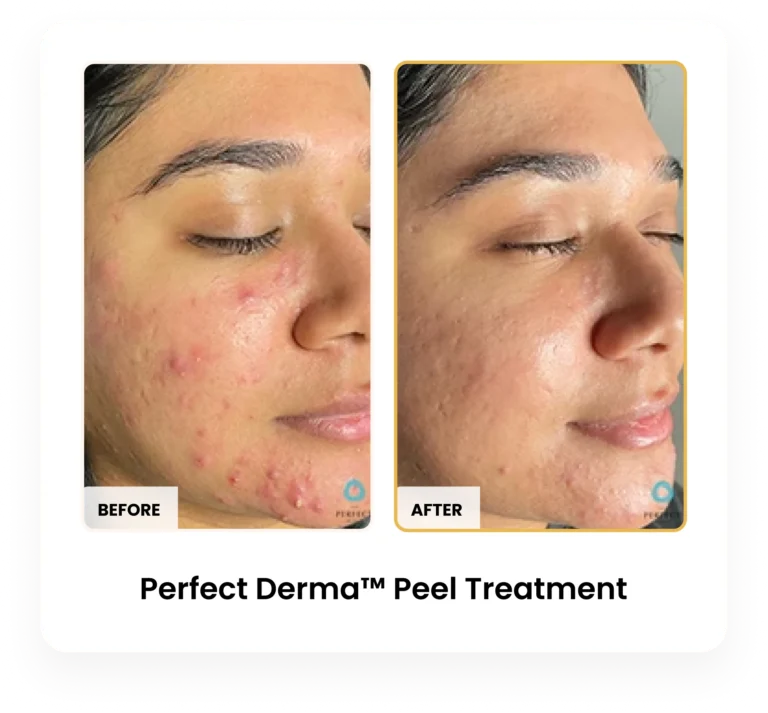 Perfect Derma Peel before and after results at Blessed Beauty Boutique in Phoenix, Arizona