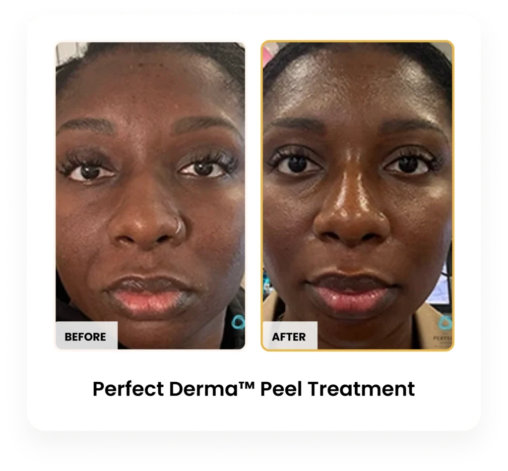 Perfect Derma Peel before and after results at Blessed Beauty Boutique in Phoenix, Arizona