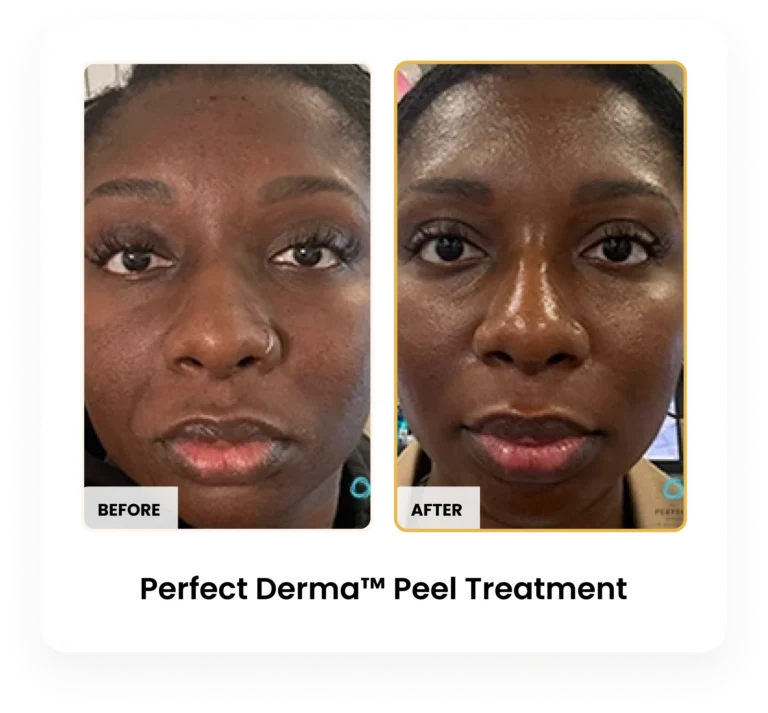 Perfect Derma Peel before and after results at Blessed Beauty Boutique in Phoenix, Arizona