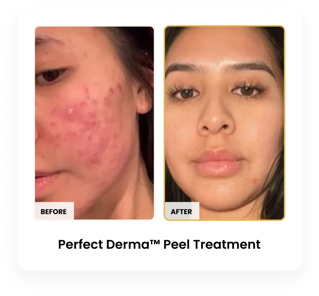 Perfect Derma Peel before and after results at Blessed Beauty Boutique in Phoenix, Arizona