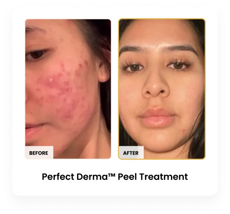 Perfect Derma Peel before and after results at Blessed Beauty Boutique in Phoenix, Arizona
