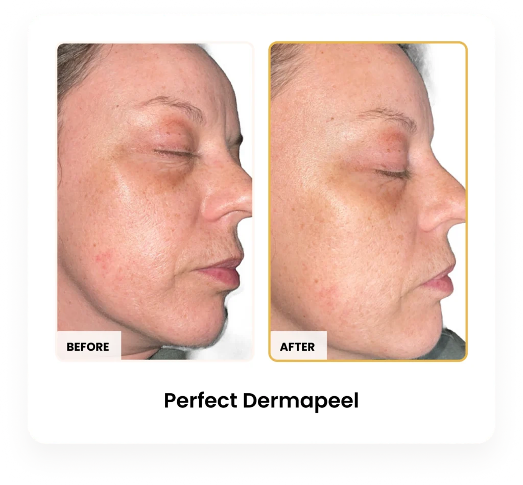 Perfect Derma Peel before and after results at Blessed Beauty Boutique in Phoenix, Arizona