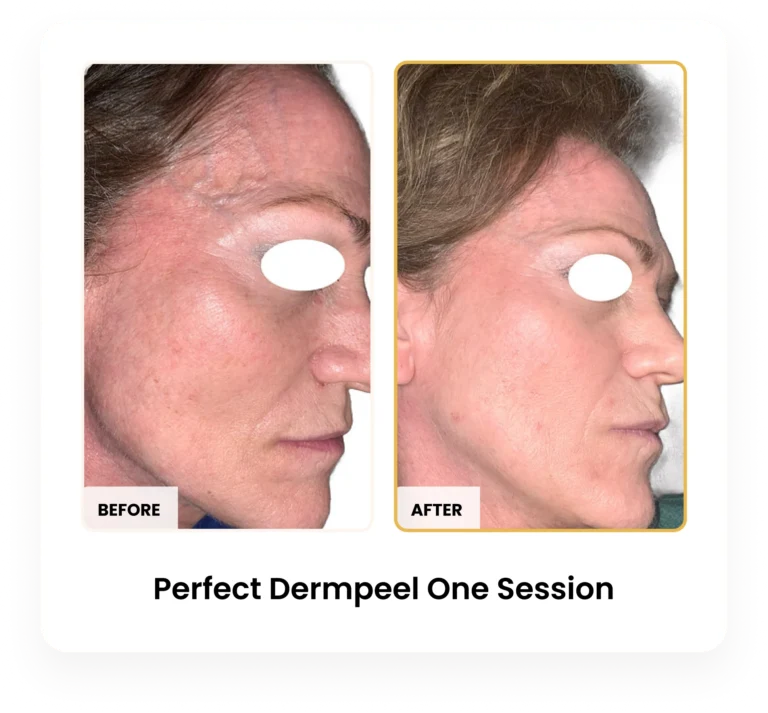 Perfect Derma Peel After One Session before and after results at Blessed Beauty Boutique in Phoenix, Arizona