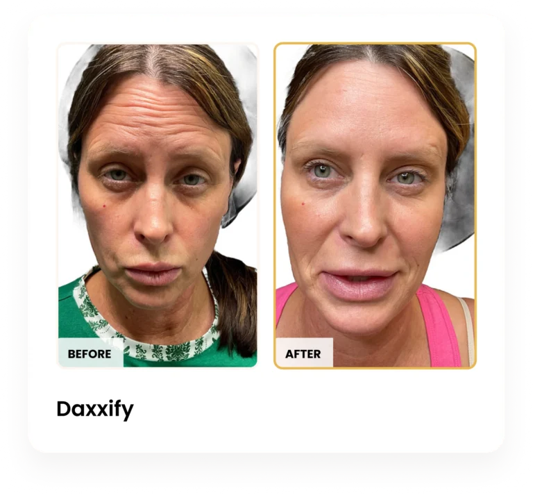 Daxxify before and after results at Blessed Beauty Boutique in Phoenix, Arizona