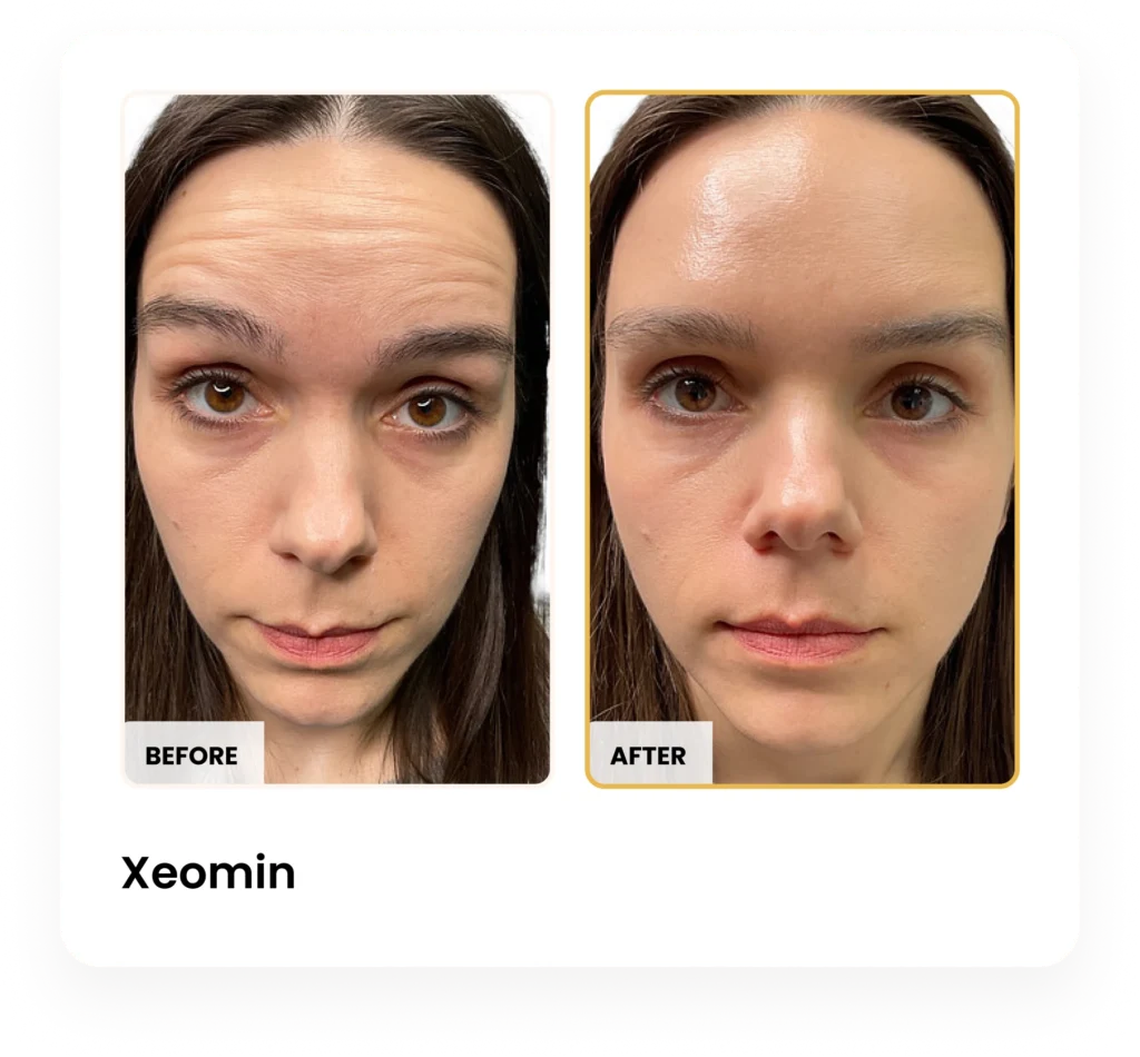 Xeomin before and after results at Blessed Beauty Boutique in Phoenix, Arizona