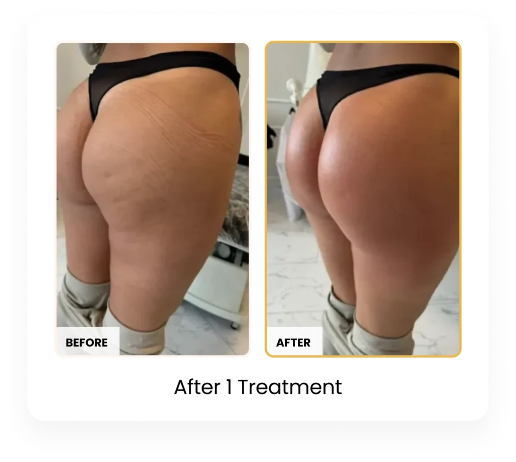 T-Shape 2 Body Contouring After 1 Treatment before and after results at Blessed Beauty Boutique in Phoenix, Arizona