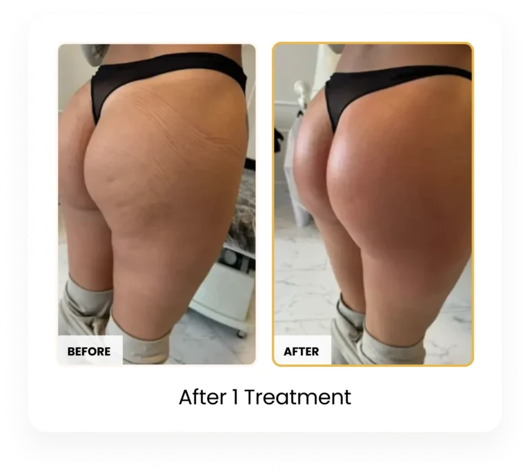 T-Shape 2 Body Contouring After 1 Treatment before and after results at Blessed Beauty Boutique in Phoenix, Arizona