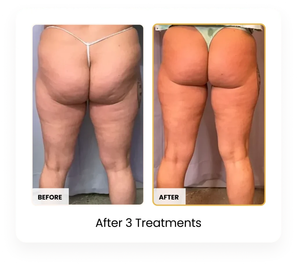T-Shape 2 Body Contouring After 3 Treatments before and after results at Blessed Beauty Boutique in Phoenix, Arizona