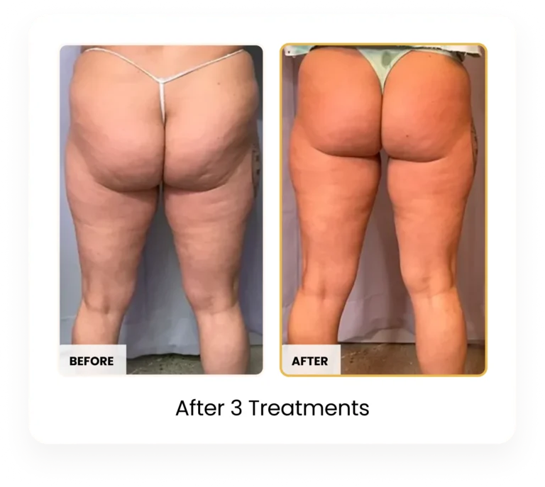 T-Shape 2 Body Contouring After 3 Treatments before and after results at Blessed Beauty Boutique in Phoenix, Arizona