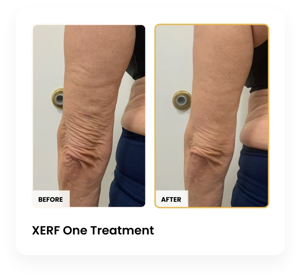 XERF After One Treatment before and after results at Blessed Beauty Boutique in Phoenix, Arizona