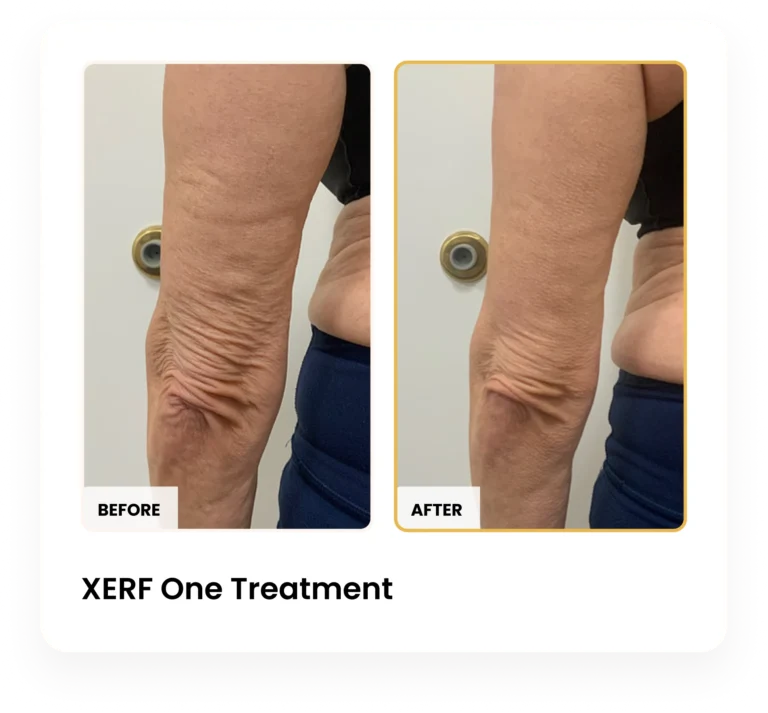 XERF After One Treatment before and after results at Blessed Beauty Boutique in Phoenix, Arizona