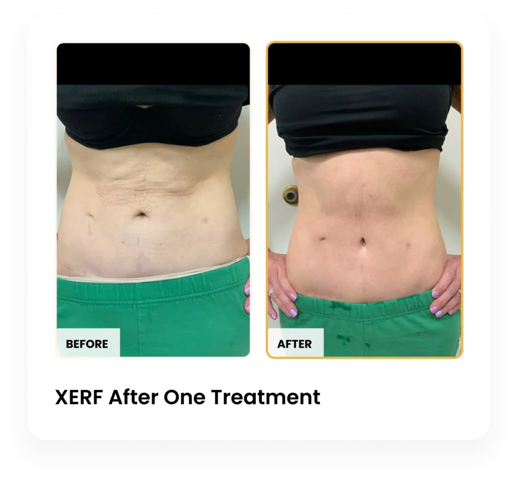 XERF After One Treatment before and after results at Blessed Beauty Boutique in Phoenix, Arizona