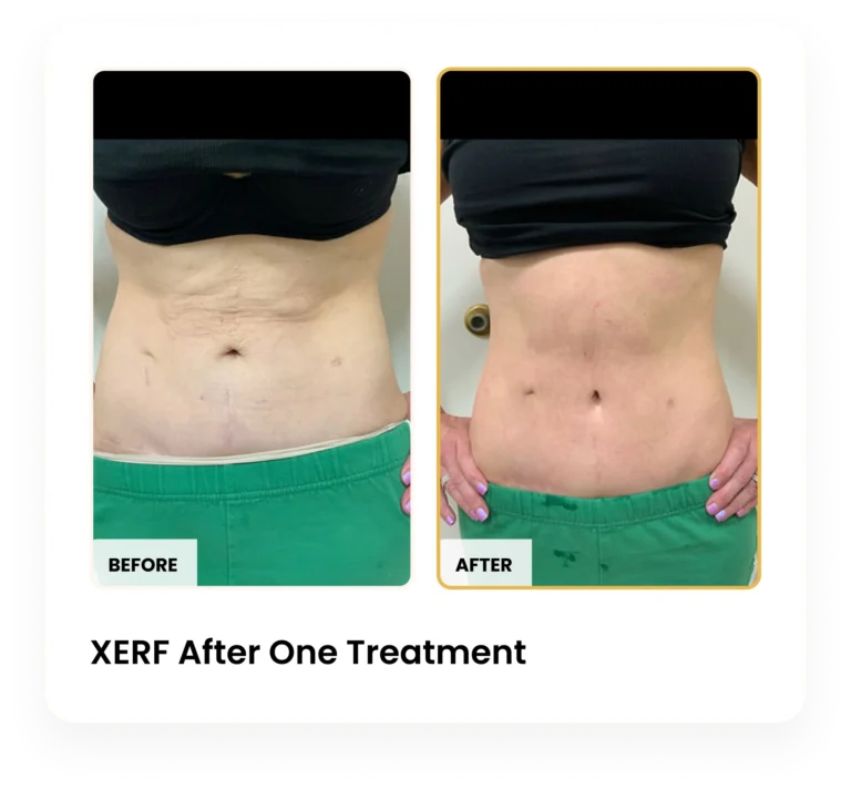 XERF After One Treatment before and after results at Blessed Beauty Boutique in Phoenix, Arizona