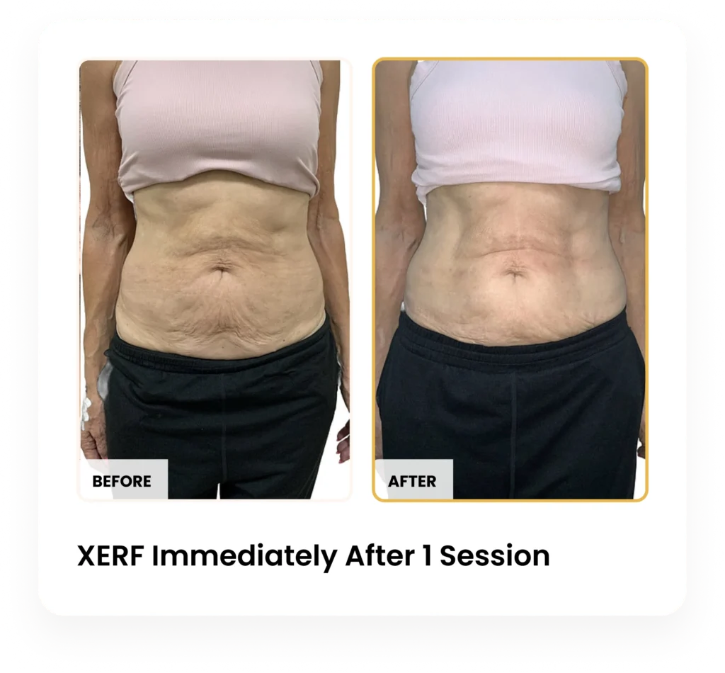 XERF Immediately After One Session before and after results at Blessed Beauty Boutique in Phoenix, Arizona
