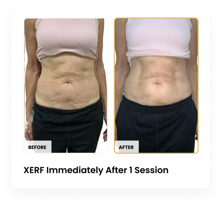 XERF Immediately After One Session before and after results at Blessed Beauty Boutique in Phoenix, Arizona