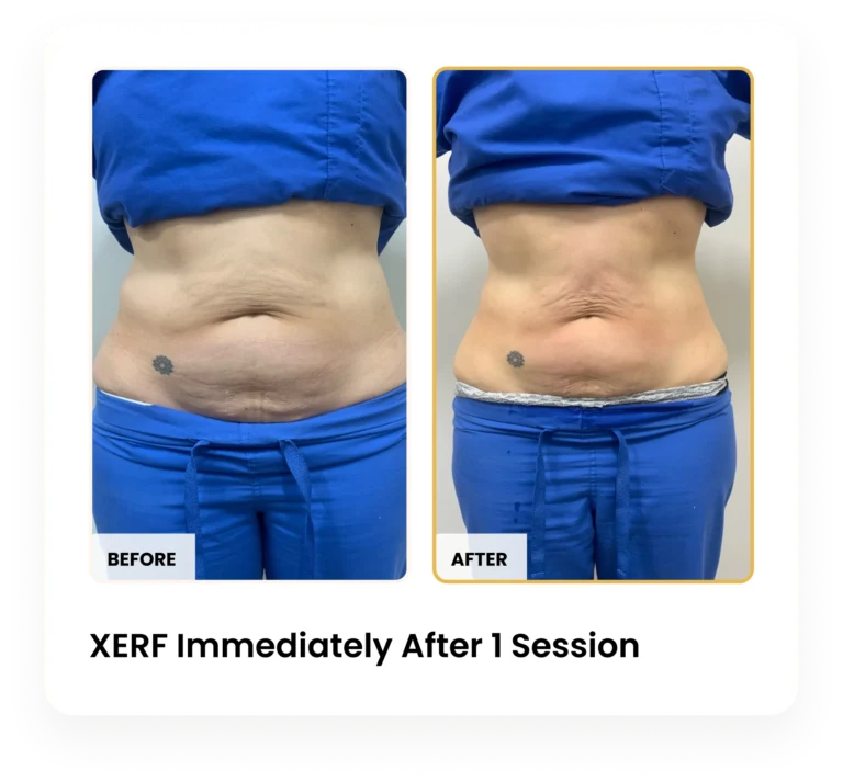 XERF Immediately After One Session before and after results at Blessed Beauty Boutique in Phoenix, Arizona