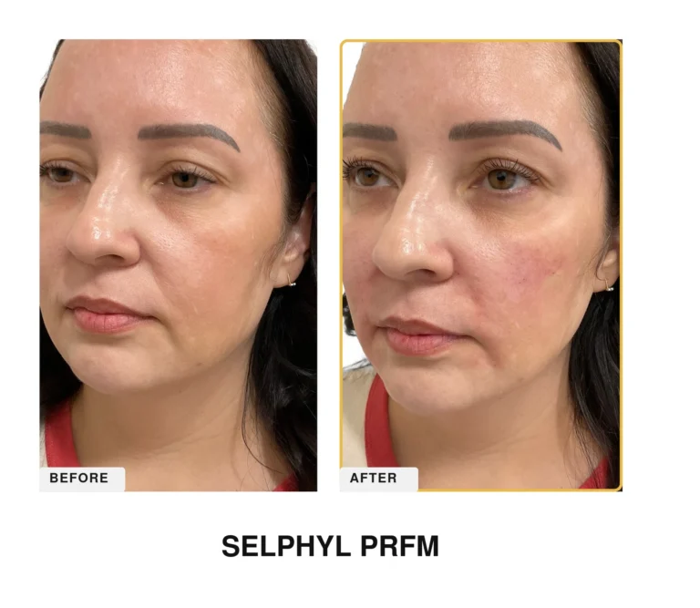 Treatment Card SELPHYL 1