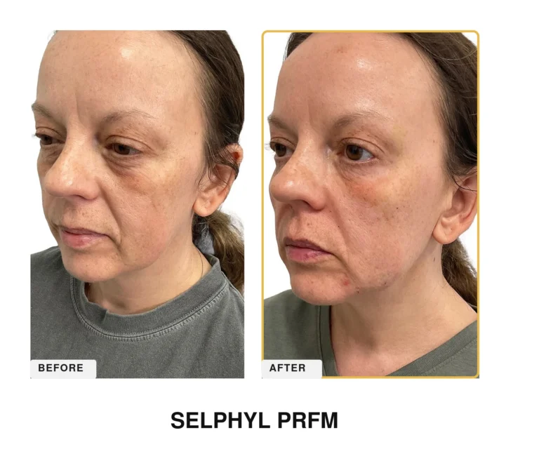 Treatment Card SELPHYL 2