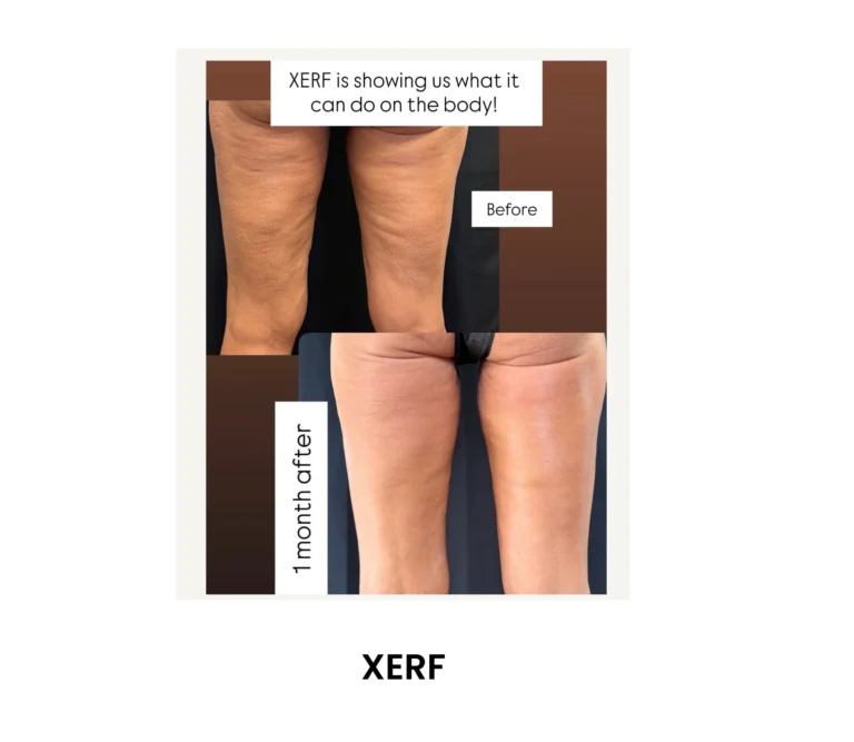 XERF After One Month before and after results at Blessed Beauty Boutique in Phoenix, Arizona