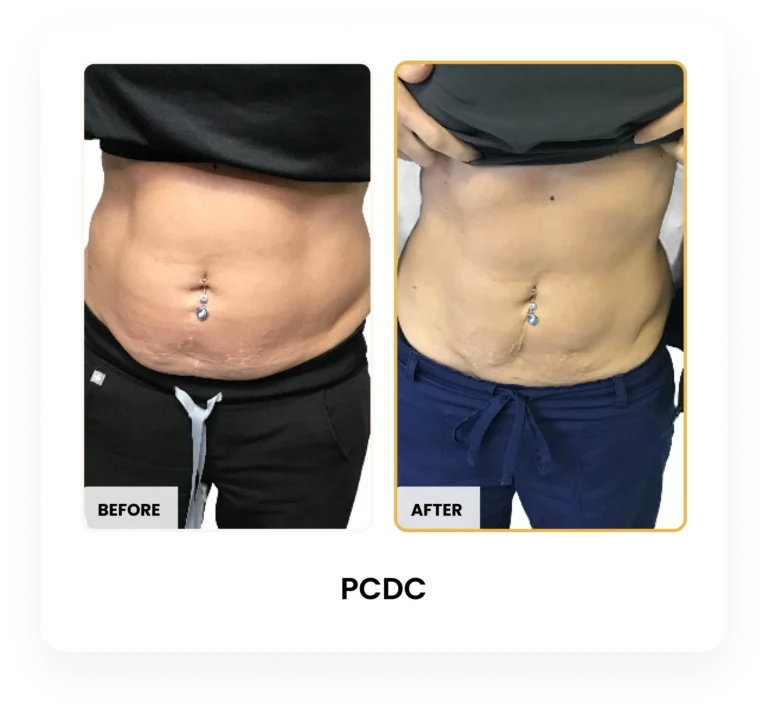 Liquid Lipo PCDC before and after results at Blessed Beauty Boutique in Phoenix, Arizona