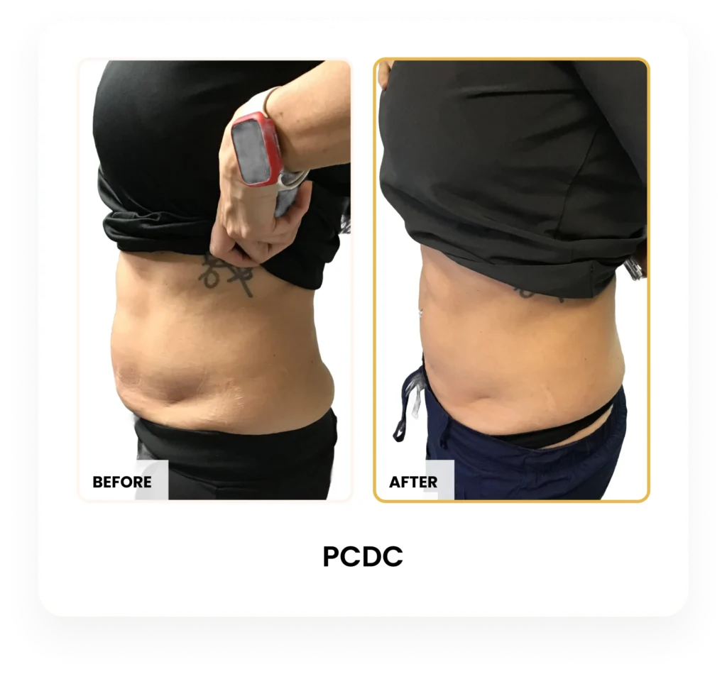 Liquid Lipo PCDC before and after results at Blessed Beauty Boutique in Phoenix, Arizona