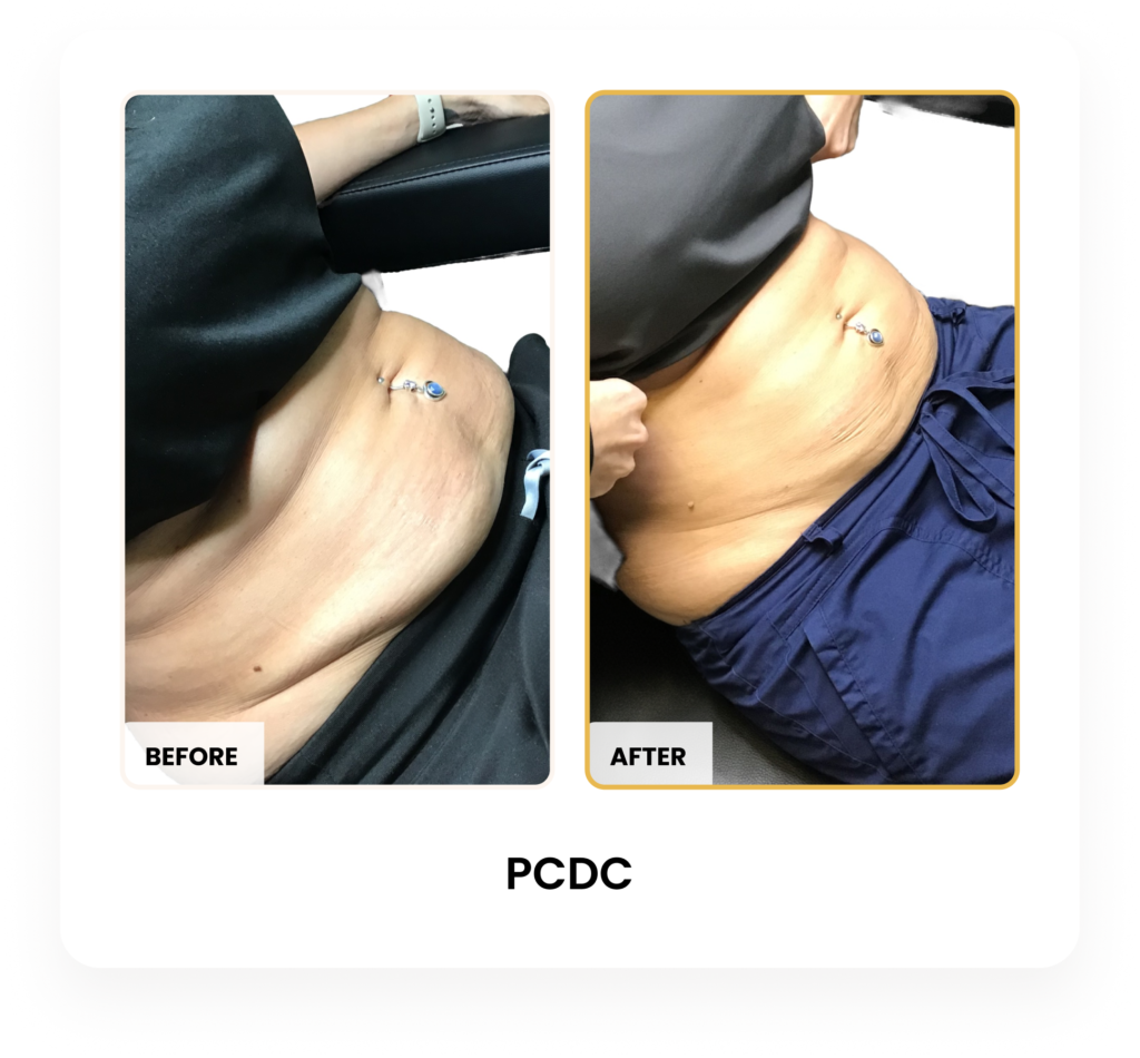 Liquid Lipo PCDC before and after results at Blessed Beauty Boutique in Phoenix, Arizona