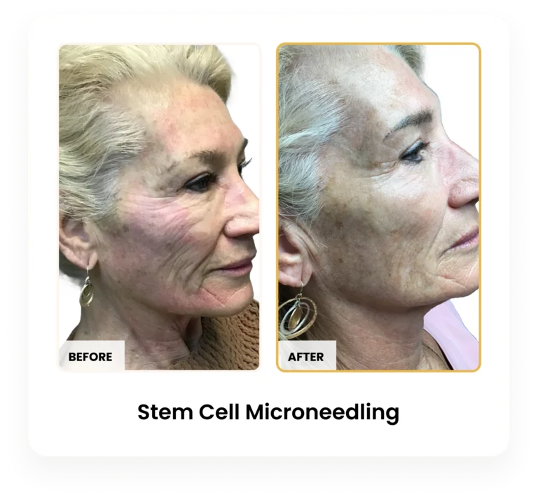 Stem Cell Microneedling before and after results at Blessed Beauty Boutique in Phoenix, Arizona