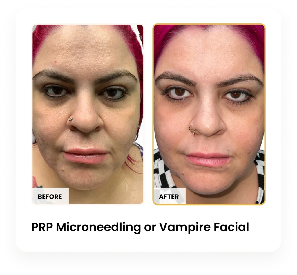 PRP Microneedling Vampire Facial before and after results at Blessed Beauty Boutique in Phoenix, Arizona