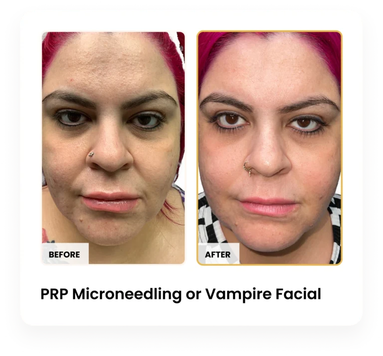 PRP Microneedling Vampire Facial before and after results at Blessed Beauty Boutique in Phoenix, Arizona