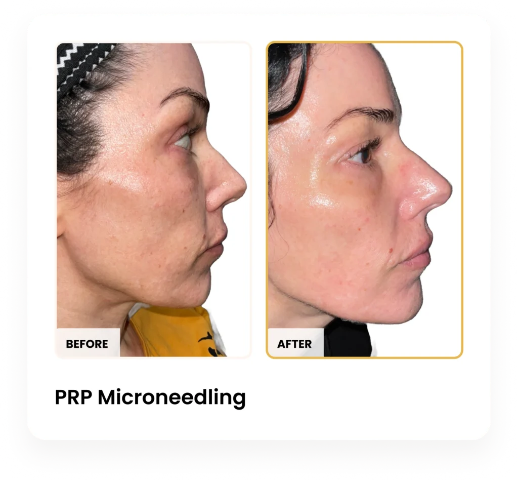 PRP Microneedling before and after results at Blessed Beauty Boutique in Phoenix, Arizona
