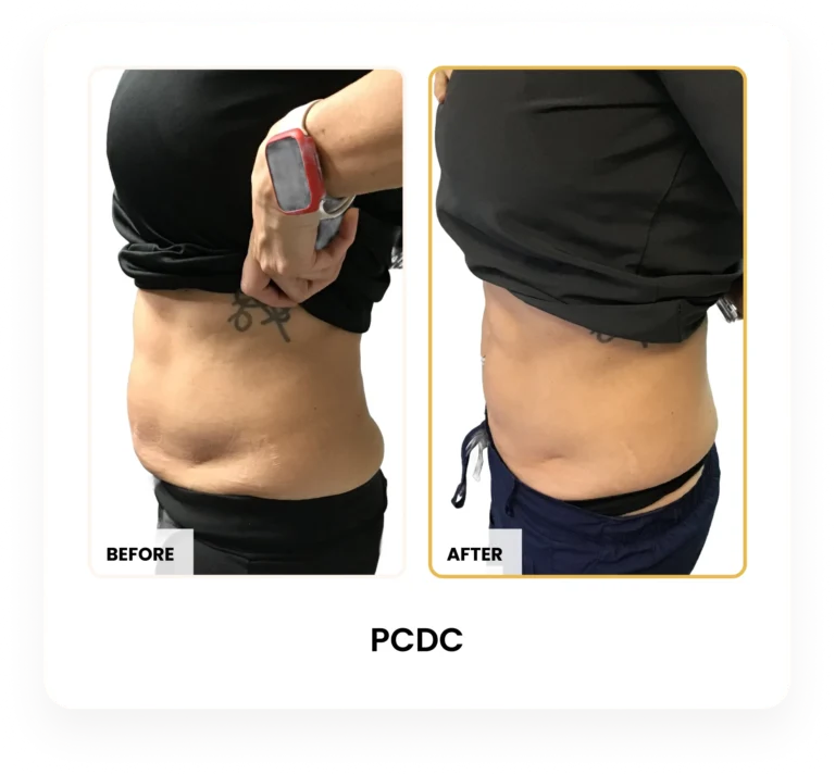 Liquid Lipo PCDC before and after results at Blessed Beauty Boutique in Phoenix, Arizona