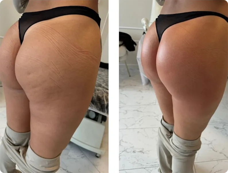 1 Treatment T-Shape 2 Body Contouring, after 1 treatment