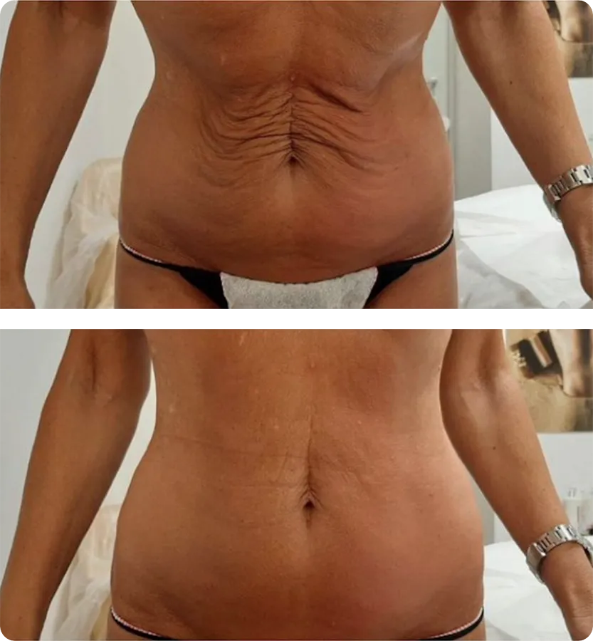3 Treatments belly T-Shape 2 Belly Contouring, after 3 treatment