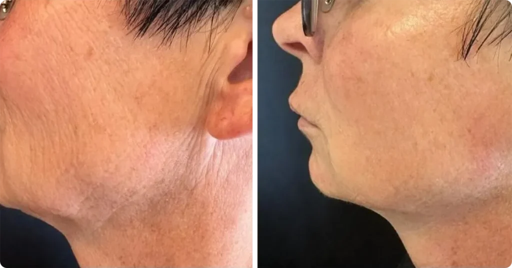 3 Treatments face T-Shape 2 Face Contouring, after 3 treatment
