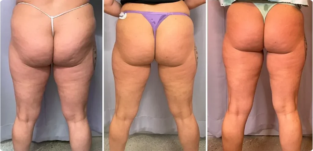 3 Treatments thighs T-Shape 2 Thigh Contouring, after 3 treatment