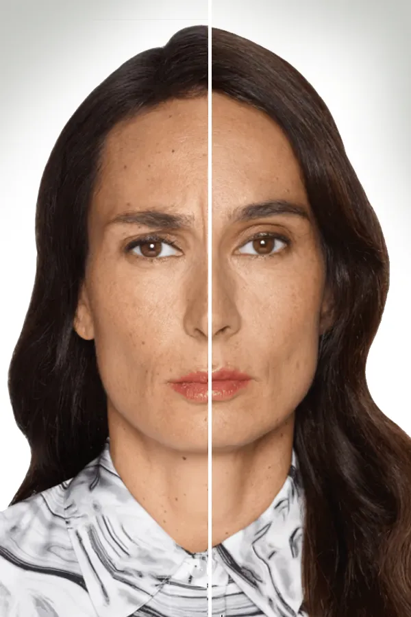 Daxxify-Frown-Line-Therapy-Treatment Before and After photo of Daxxify treatment. Get Daxxify treatment for frown lines from Blessed Beauty Boutique in Greater Phoenix.