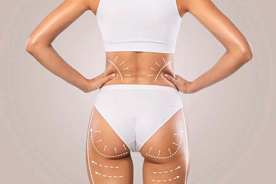 Radiesse-Butt-Lift-Clinic A woman seen from behind, with illustrated markings showing where a butt lift procedure would occur. Get Radiesse Butt Lift treatment from Blessed Beauty Boutique in Greater Phoenix.