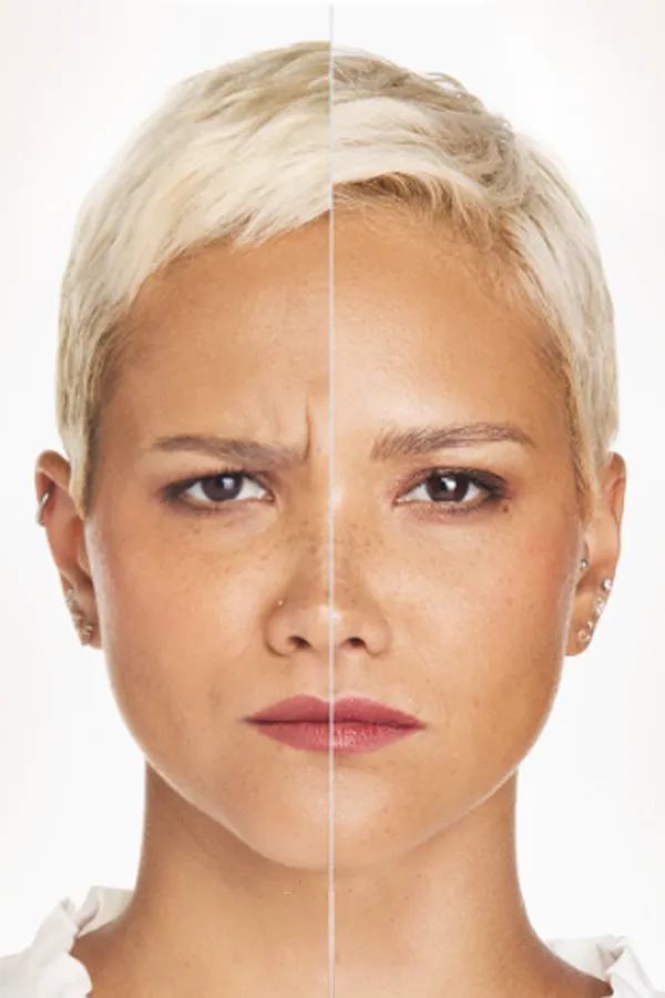 Xeomin-Facial-Injections-Treatment A before and after image of Xeomin Facial Injections. Get Xeomin Facial Injections from Blessed Beauty Boutique in Greater Phoenix.